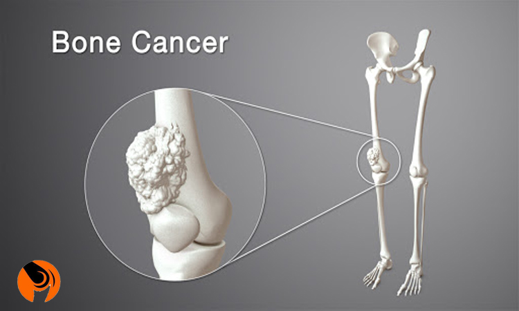 تومور استخوانی از آسیب هایی که توسط متخصص ارتوپد درمان می شود