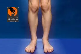 زانوی ضربدری