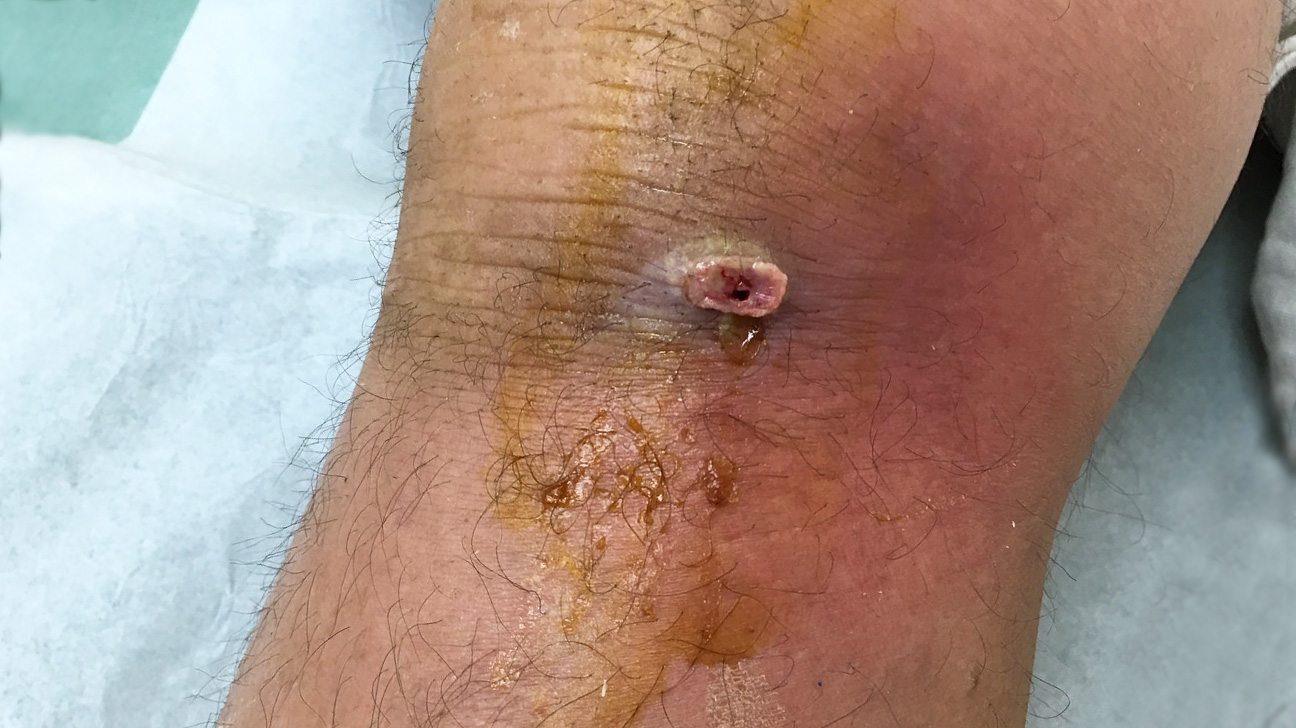 Knee infection