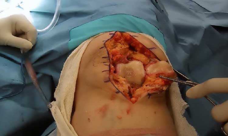 عوارض جراحی مفصل زانو