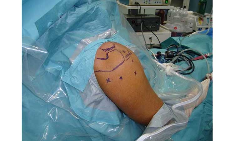 عمل جراحی آرتروسکوپی شانه