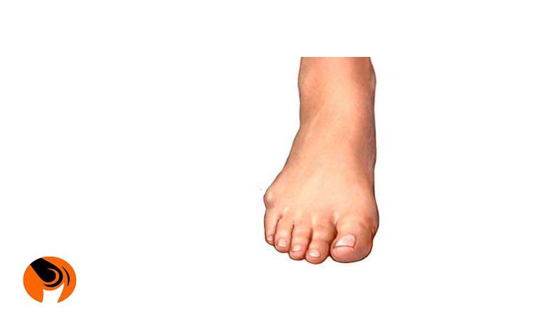 علائم بیرون زدگی استخوان کنار انگشت کوچک پا