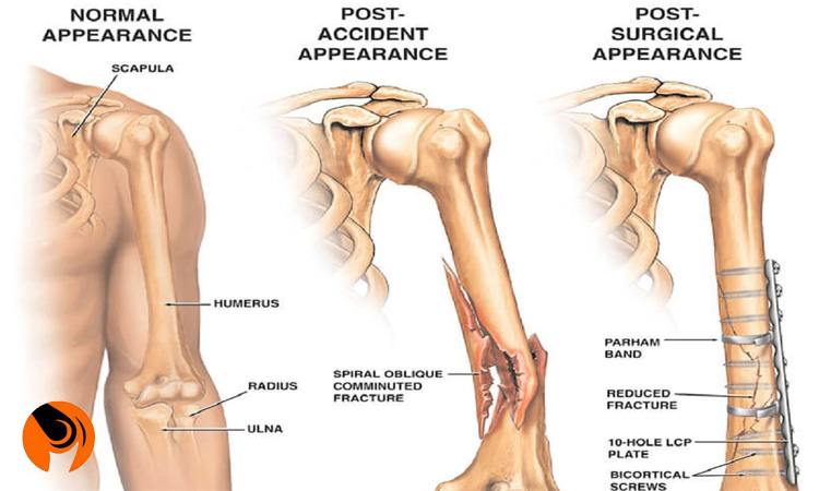 علت شکستگی استخوان بازو