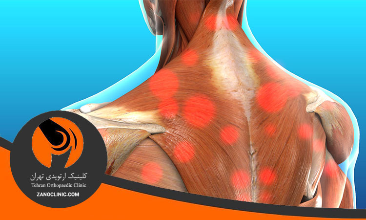 سندرم درد میوفاشیال چیست؟