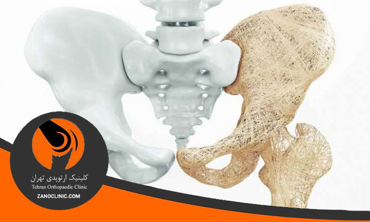 تشخیص پوکی استخوان و نرمی استخوان