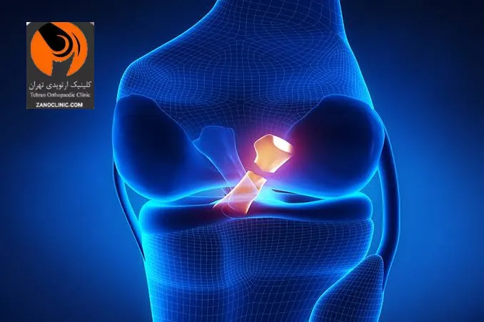 مراقبت های مهم پس از جراحی مینیسک زانو