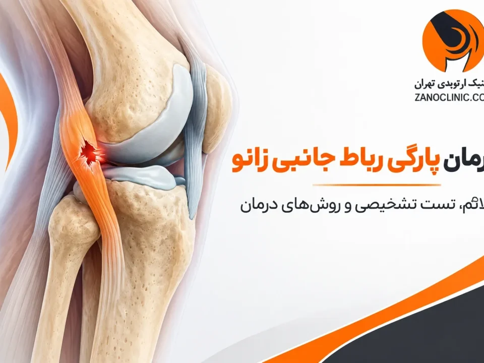 درمان پارگی رباط جانبی زانو