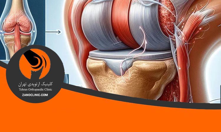 روش‌های جراحی برای درمان پارگی مجدد رباط صلیبی قدامی