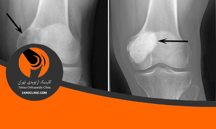 سرطان زانو چیست؟