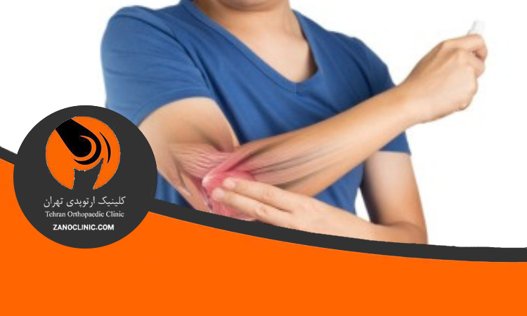 تعویض کامل مفصل آرنج