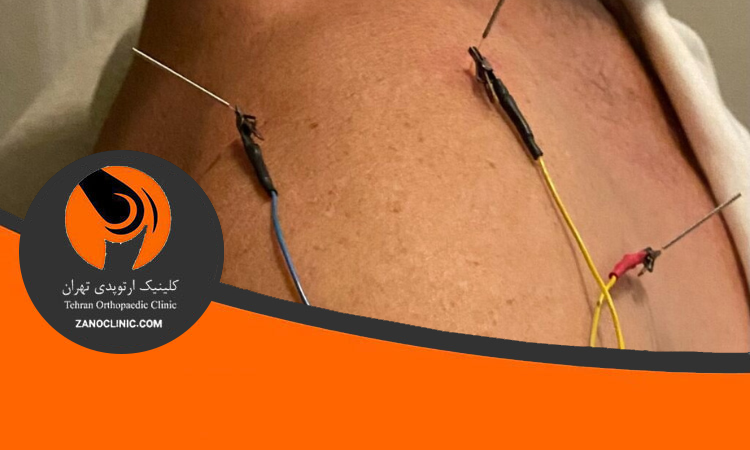 طب سوزنی برای درد شانه
