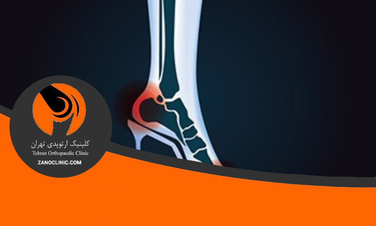 عوارض کفش پاشنه بلند