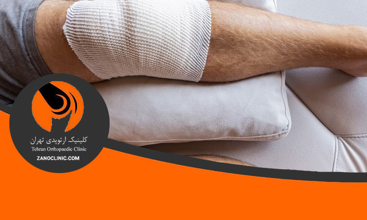 روش‌های کاهش ورم پا و درمان عوارض بعد از تعویض مفصل زانو