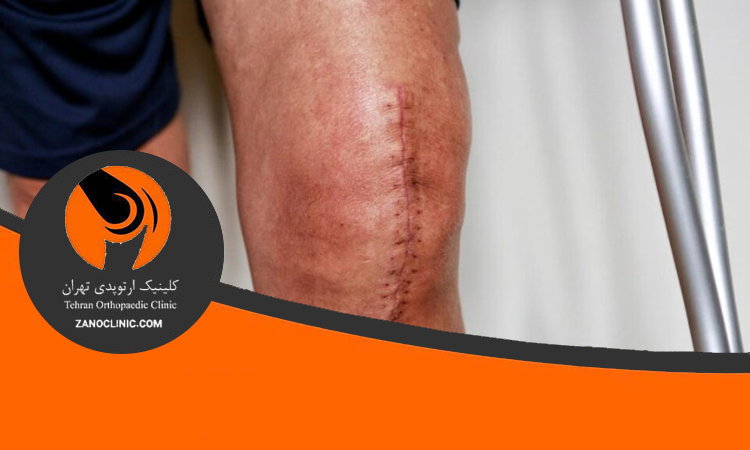 دلیل ورم پا بعد از تعویض مفصل زانو
