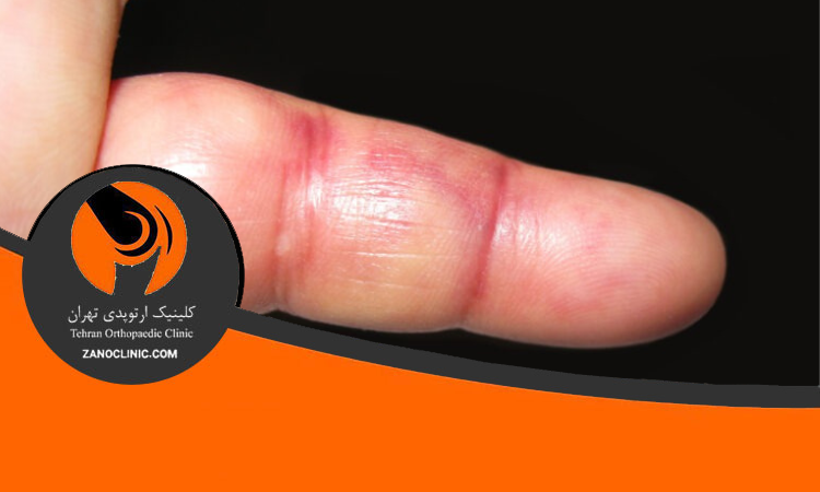 دلایل ایجاد دررفتگی انگشت دست