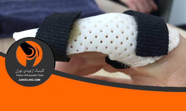 روش های درمانی دررفتگی انگشت دست