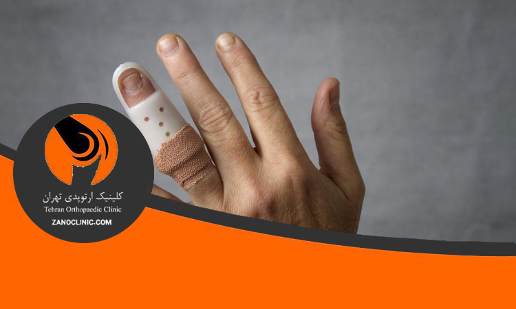 علائم در رفتگی انگشت دست