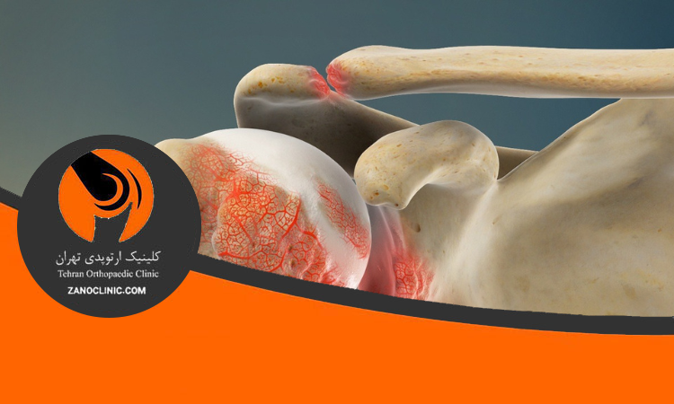 آرتروز مفصل شانه