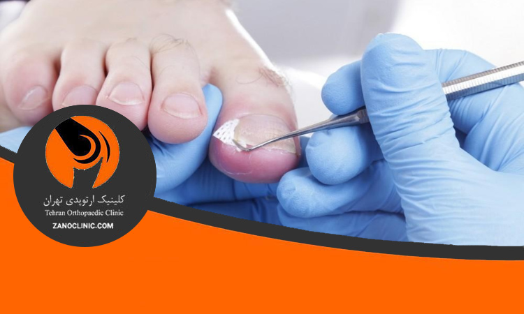 روش های درمان خانگی و تخصصی ناخن در گوشت پا