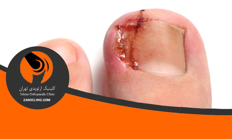 علائم و نشانه های فرو رفتن ناخن در گوشت پا