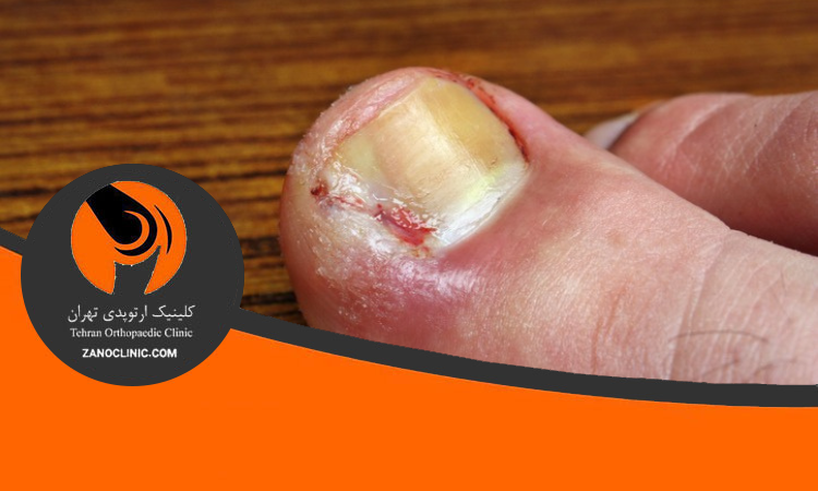 عوارض بی توجهی به درمان ناخن در گوشت پا و اهمیت مراجعه به پزشک