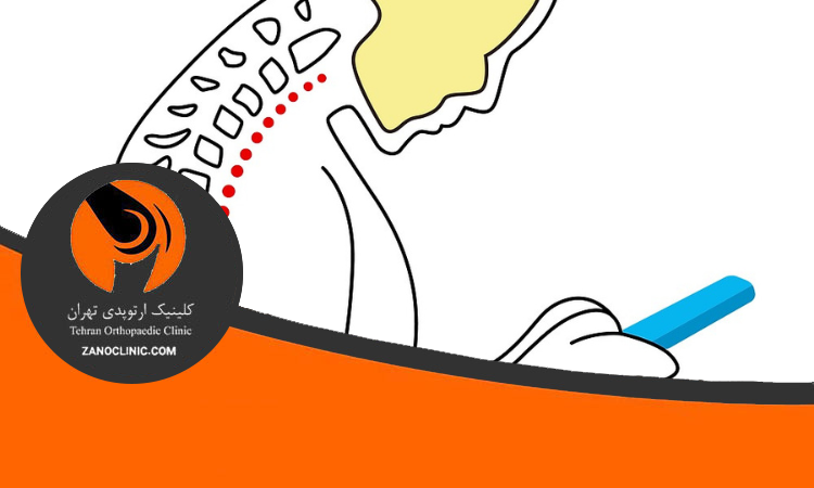 قوز گردن ناشی از موبایل و لپ تاپ