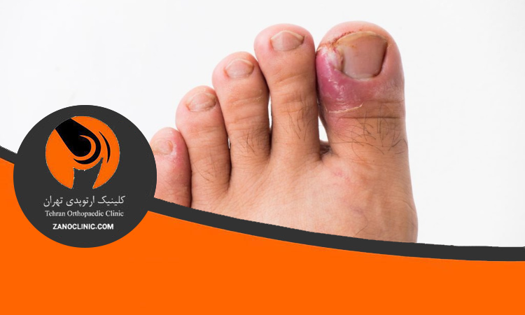 فرو رفتن ناخن در گوشت پا