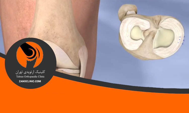 نقش غضروف ها، منیسک ها و مایع سینوویال در سلامت زانو