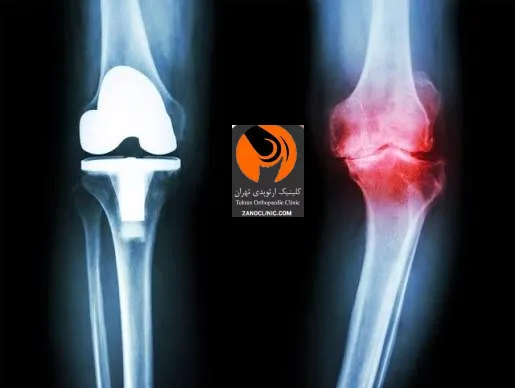 روش های جامع درمان غیر جراحی آرتروز زانو