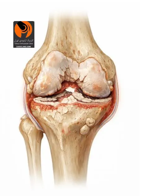 گزینه های جراحی زانو؛ از اقدامات کم تهاجمی تا بازسازی کامل