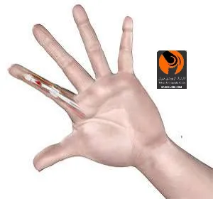 علل کشیدگی تاندون انگشت دست
