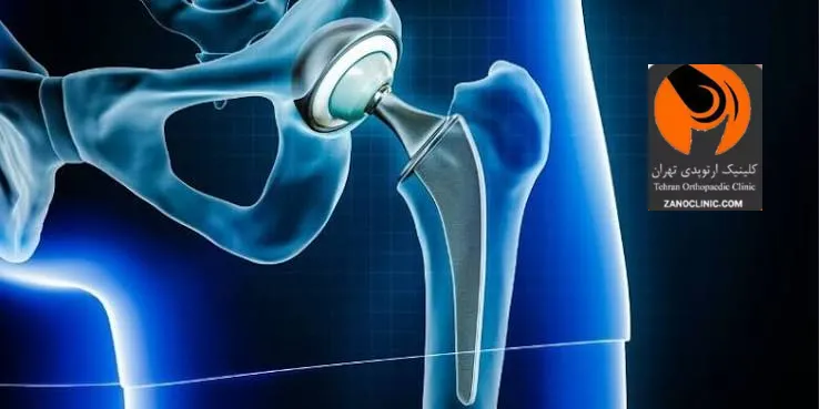 آشنایی با آناتومی مفصل لگن و اهمیت آن