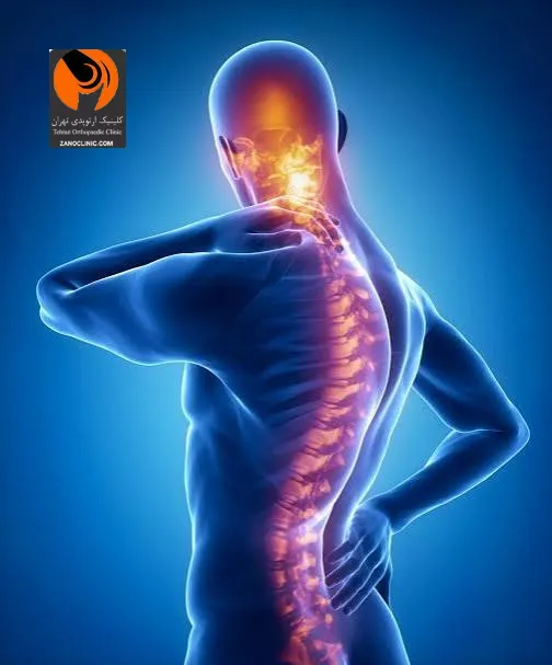 علائم تنگی کانال نخاعی