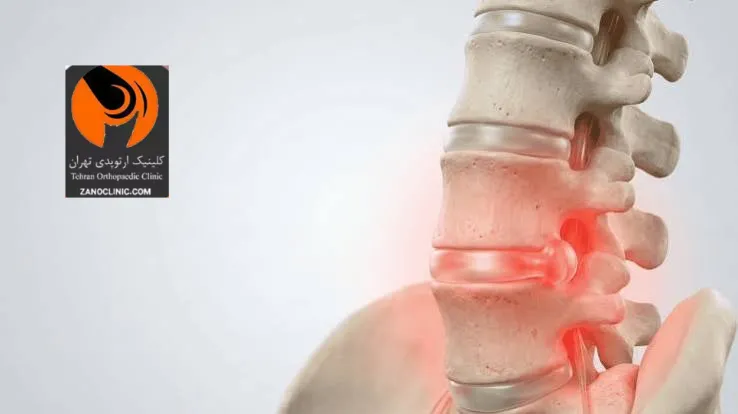 اصلی ترین علل ابتلا به آرتروز گردن