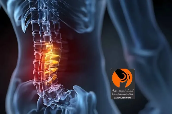چه زمانی باید برای درمان تنگی کانال نخاعی سریع به پزشک مراجعه کرد؟