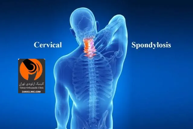 با انجام دادن چه اقداماتی از بروز آرتروز گردن جلوگیری کنیم؟
