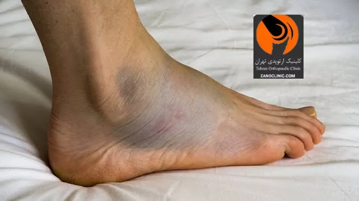 ورم پا چیست و چگونه ایجاد می شود؟