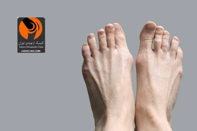 نقش کلیدی پزشک در درمان تخصصی هالوکس والگوس