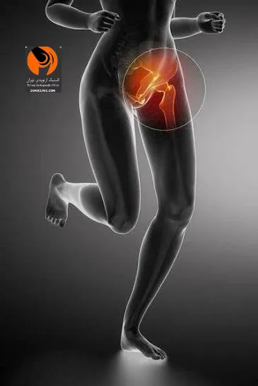 بررسی کامل روش های درمان کشیدگی کشاله ران