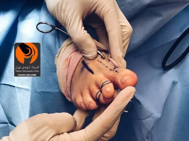 عوارض احتمالی و راهکار های پیشگیری عمل بونیونکتومی